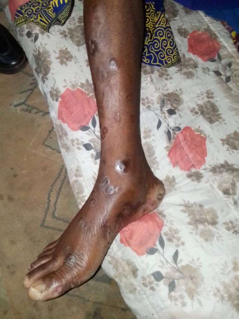 Mpox-leg suspect