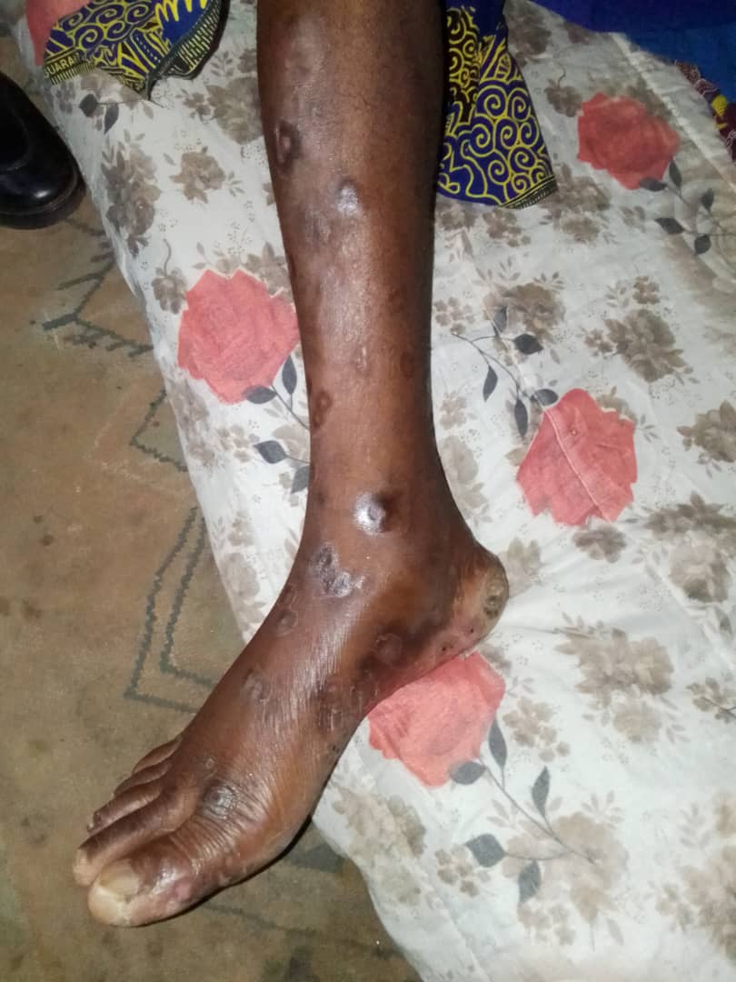 Clinical presentation of suspected Mpox lesions